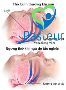 Hội chứng ngưng thở khi ngủ.