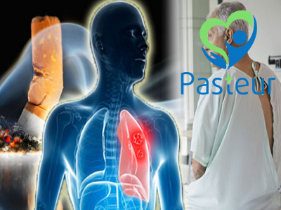 Sàng lọc ung thư phổi