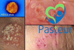 Các bệnh lây qua đường tình dục