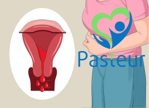 LẠC NỘI MẠC TỬ CUNG LÀ GÌ?