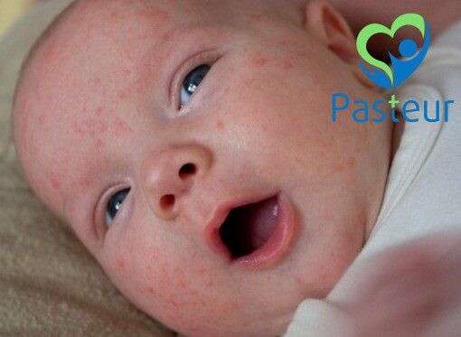 Rôm Sảy Ở Trẻ Em: Nguyên Nhân, Triệu Chứng, Cách Điều Trị & Phòng Ngừa Hiệu Quả 1 Rôm sảy ở trẻ em sẽ biến chứng nặng nếu như không chú ý đến