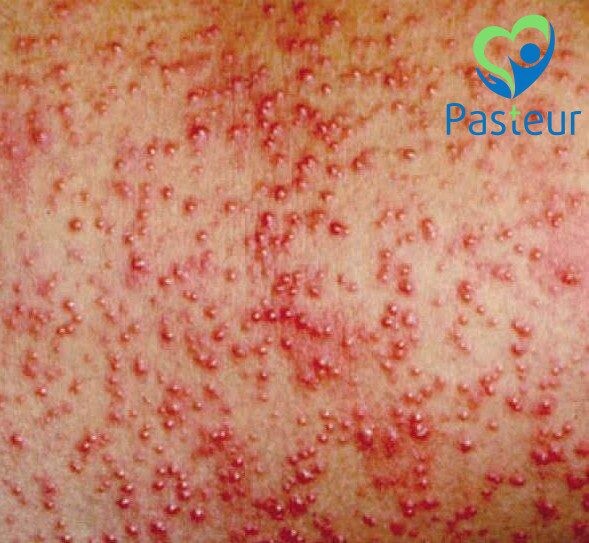 Rôm Sảy Ở Trẻ Em: Nguyên Nhân, Triệu Chứng, Cách Điều Trị & Phòng Ngừa Hiệu Quả 2 Rôm Sảy Ở Trẻ Em: Nguyên Nhân, Triệu Chứng, Cách Điều Trị & Phòng Ngừa Hiệu Quả Ảnh minh họa