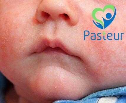 Rôm Sảy Ở Trẻ Em: Nguyên Nhân, Triệu Chứng, Cách Điều Trị & Phòng Ngừa Hiệu Quả 3 Rôm Sảy Ở Trẻ Em: Nguyên Nhân, Triệu Chứng, Cách Điều Trị & Phòng Ngừa Hiệu Quả Ảnh minh họa