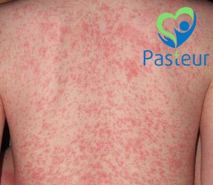 Rôm Sảy Ở Trẻ Em: Nguyên Nhân, Triệu Chứng, Cách Điều Trị & Phòng Ngừa Hiệu Quả 4 Rôm Sảy Ở Trẻ Em: Nguyên Nhân, Triệu Chứng, Cách Điều Trị & Phòng Ngừa Hiệu Quả Ảnh minh họa