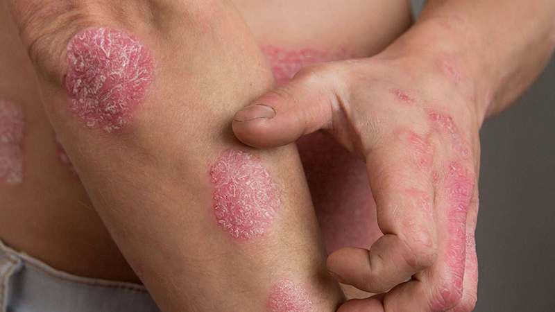 6 cách để kiểm soát tình trạng ngứa da ở bệnh nhân vảy nến Ảnh minh họa