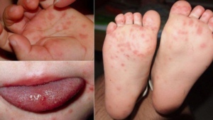 Bệnh tay chân miệng ở trẻ em - Nguyên nhân và cách nhận biết Ảnh minh họa