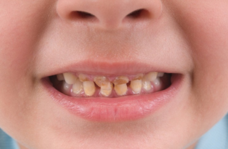 Răng sữa của bé đổi màu, bố mẹ có nên lo lắng? Ảnh minh họa
