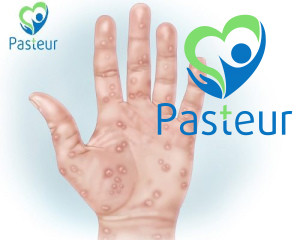 Bệnh Giang Mai Là Gì?Các Dấu Hiệu & Triệu Chứng Ảnh minh họa