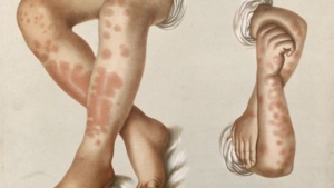 Hồng ban nút là bệnh gì? 4 điều cần biết về hồng ban nút Ảnh minh họa