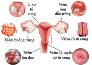 BỆNH VIÊM ỐNG DẪN TRỨNG Ở PHỤ NỮ CÓ NGUY HIỂM KHÔNG