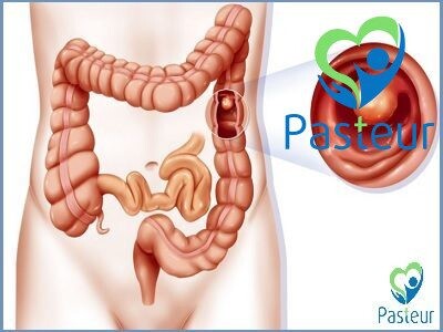 Cần làm gì tiếp theo sau khi đã cắt bỏ polyp