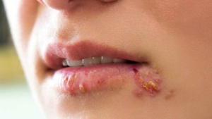 Chốc mép có lây không? Cách phòng ngừa chốc mép Ảnh minh họa