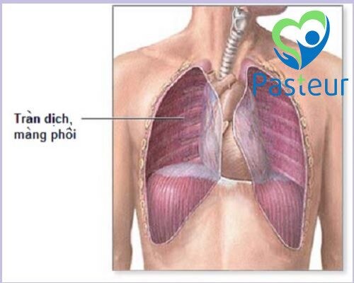 Biến chứng của viêm phổi