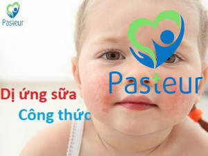 Xử lý trường hợp trẻ bị dị ứng với sữa công thức Ảnh minh họa