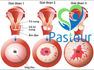 Tầm soát ung thư cổ tử cung: Bảo vệ sức khỏe phụ nữ toàn diện Ảnh minh họa