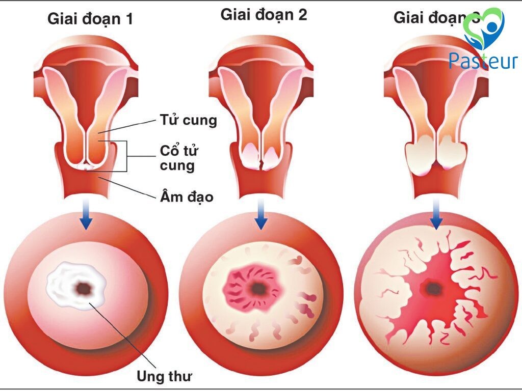 Tầm soát ung thư cổ tử cung: Bảo vệ sức khỏe phụ nữ toàn diện Ảnh minh họa