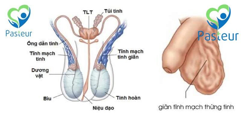GIÃN TĨNH MẠCH THỪNG TINH LÀ GÌ? Ảnh minh họa