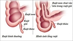 3 điều cần biết về lồng ruột ở trẻ nhỏ Ảnh minh họa