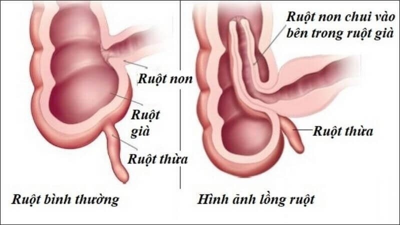 3 điều cần biết về lồng ruột ở trẻ nhỏ Ảnh minh họa