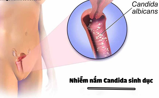 NẤM CANDIDA VÀ NHỮNG ĐIỀU KHÔNG THỂ BỎ QUA