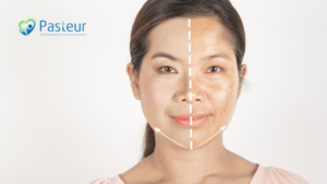 Nám da và cách chăm sóc Ảnh minh họa