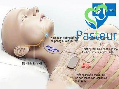 Ngưng thở khi ngủ là gì? Có nguy hiểm không Ảnh minh họa