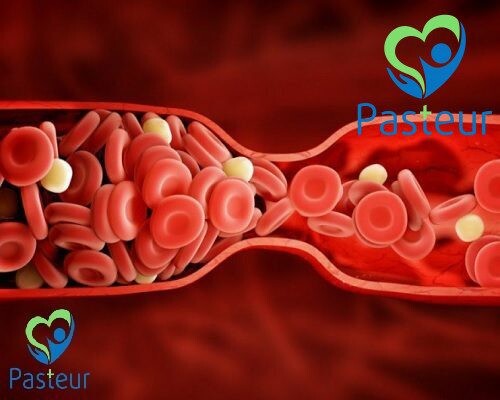 Bệnh Lý Huyết Khối Trong Thai Kỳ Là Gì 3 Ngăn Ngừa Và Điều Trị Cục Máu Đông Trong Thai Kỳ