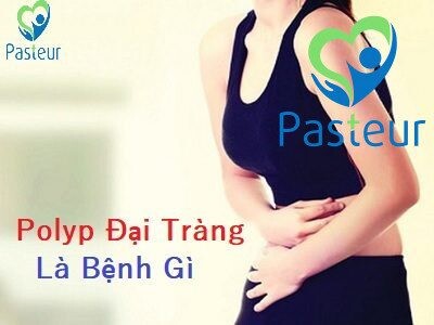 Polyp đại tràng là gì