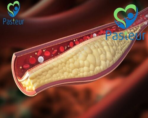Các triệu chứng, nguyên nhân làm tăng Cholesterol trong máu 4 Các triệu chứng, nguyên nhân làm tăng Cholesterol trong máu Ảnh minh họa