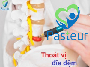 Thoát vị đĩa đệm là gì? Các triệu chứng và nguyên nhân Ảnh minh họa