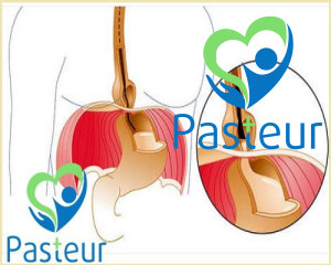 Trào ngược dạ dày thực quản (Gerd) là gì? Nguyên nhân và biến chứng Ảnh minh họa