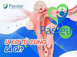 U xơ tử cung là gì? Triệu chứng và chẩn đoán bệnh Ảnh minh họa
