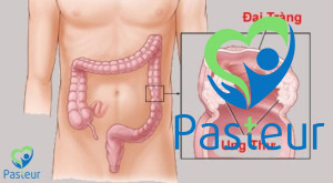 Ung thư đại trực tràng là gì? Các dấu hiệu phát hiện sớm Ảnh minh họa