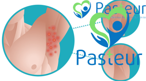 Điều trị viêm tuyến mồ hôi mủ