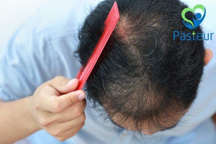 Tìm hiểu về rụng tóc Telogen Effluvium Nguyên nhân và biện pháp khắc phục