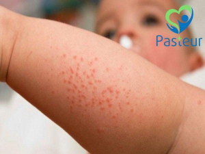 Bệnh xuất huyết giảm tiểu cầu