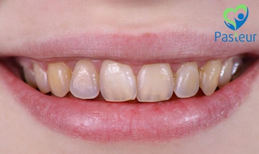 Mòn Răng: Nguyên Nhân, Triệu Chứng & Cách Điều Trị | Phòng Khám Pasteur 1 Nguyên nhân của tình trạng mòn răng