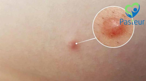 Cách điều trị u bã đậu hiệu quả