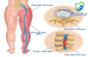 Nguyên nhân gây đau thần kinh tọa