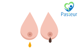 Tiết dịch núm vú