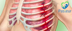 Triệu chứng của gãy xương sườn