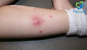 Viêm tuyến mồ hôi mủ