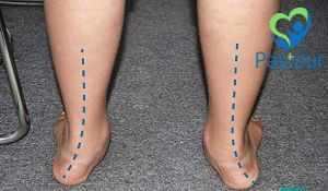 Triệu chứng của bàn chân bẹt