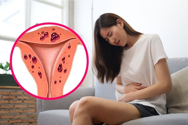 Lạc nội mạc tử cung: căn bệnh không thể chủ quan Ảnh minh họa