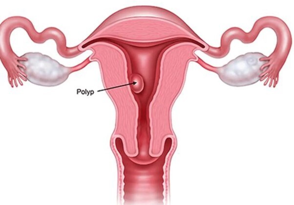 Polyp cổ tử cung khi mang thai có gây nguy hiểm đến thai nhi không? Ảnh minh họa