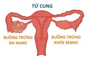 buồng trứng đa nang là gì?