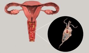 nguyên nhân viêm âm đạo