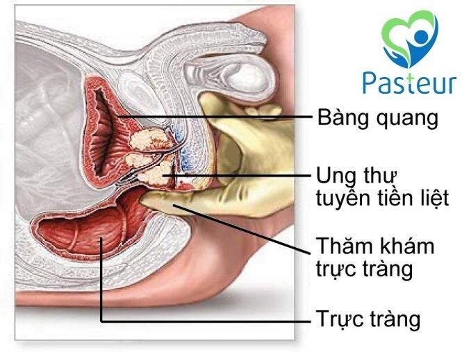 Ung Thư Tuyến Tiền Liệt: Hiểu Rõ Để Phòng Ngừa Và Điều Trị Hiệu Quả Ảnh minh họa