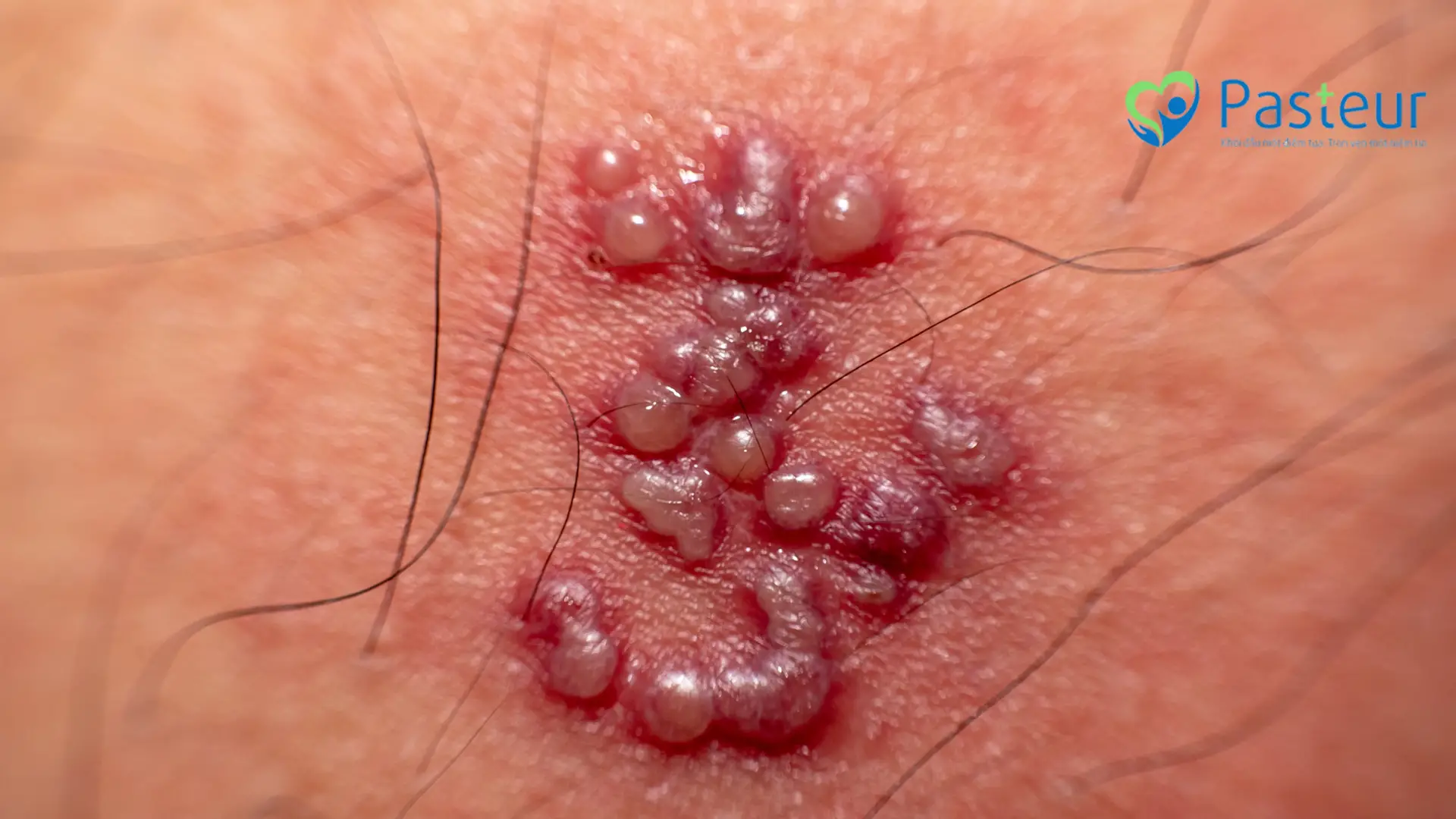 Herpes sinh dục Herpes sinh dục