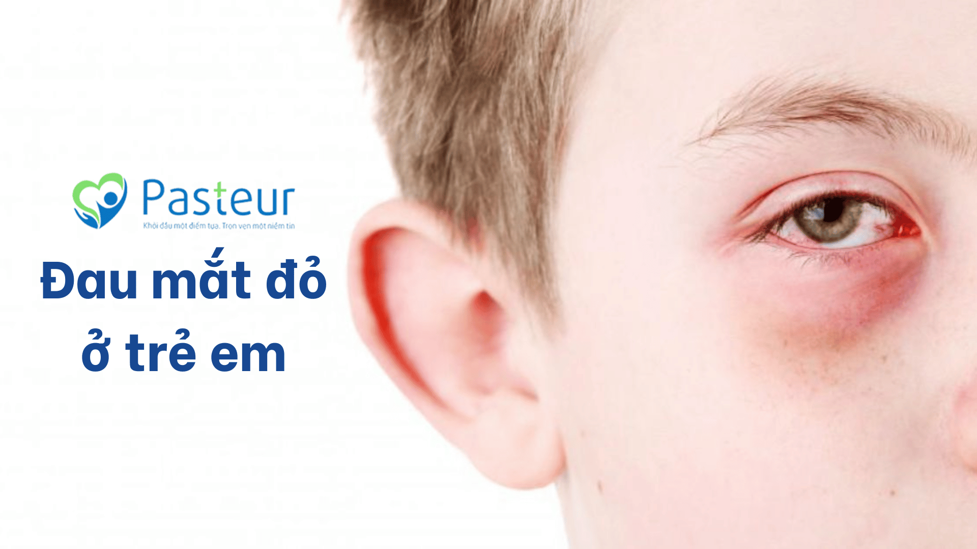 Đau Mắt Đỏ Ở Trẻ Em: Dấu Hiệu, Cách Chăm Sóc & Phòng Ngừa Hiệu Quả Ảnh minh họa